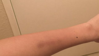 Breitbart Reporter Posts Bruised Arm Pic After Trump Campaign Manager Calls Her a Liar (Photo)