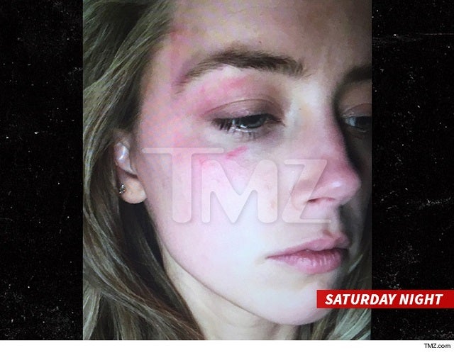 amber heard bruise