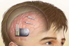 Meet the Human Cyborg Who Could Pave the Way for the Future