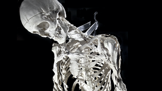 We Need a Movie About Harry Eastlack, the Man With Two Skeletons