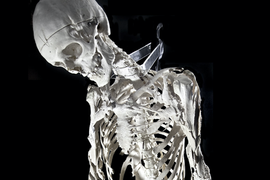 We Need a Movie About Harry Eastlack, the Man With Two Skeletons