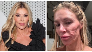 ‘Real Housewives’ Star Brandi Glanville Says ‘Parasite That Jumps Around My Face’ Is Responsible for Dramatic Change in Appearance